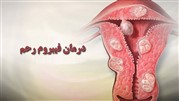 معرفی روش‌های درمان فیبروم رحم و میزان موفقیت و عوارض هر یک