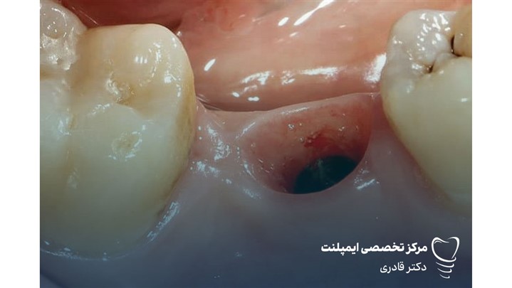 قیمت و هزینه ایمپلنت کره ای قیمت و هزینه ایمپلنت کره ای