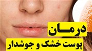 آشنایی با تکنیک‎های درمان پوست خشک و جوشدار