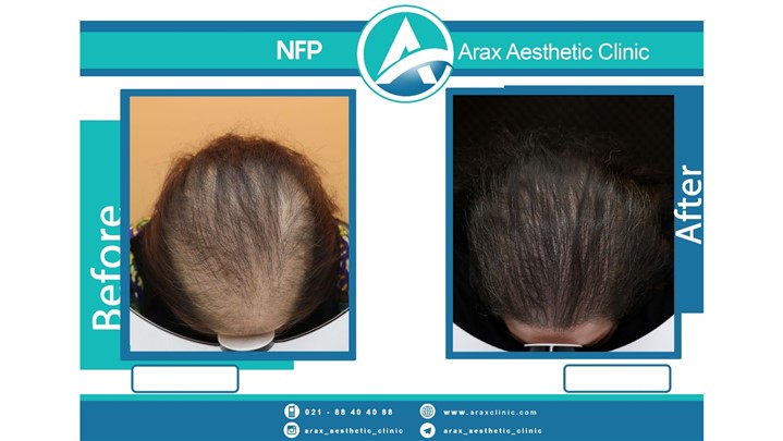  روش NFP برای درمان قطعی ریزش مو در ایران اجرا شد