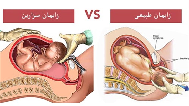 درباره زایمان در آب بیشتر بدانیم