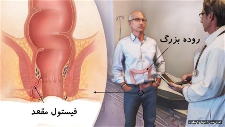 درمان فیستول مقعدی با لیزر، راه قطعی و بدون عمل جراحی درمان فیستول مقعدی با لیزر، راه قطعی و بدون عمل جراحی