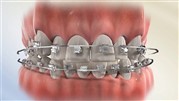 ارتودنسی ثابت چگونه دندان ها را صاف و مرتب می کند؟