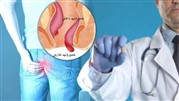 علائم بواسیر داخلی درجه ۱،۲،۳ و ۴ چیست؟ 