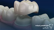 چرا روکش دندان می افتد 