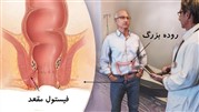 درمان فیستول مقعدی با لیزر، راه قطعی و بدون عمل جراحی