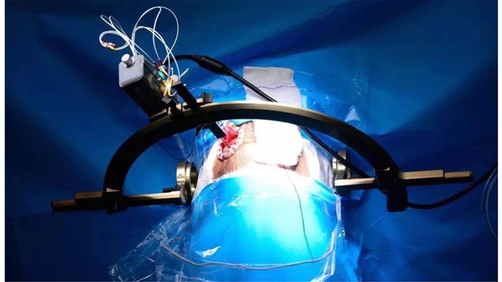 نخستین عمل جراحی از راه دور در بستر 5G توسط هواوی در چین