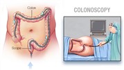 نحوه‌ انجام کولونوسکوپی در ایران کلینیک و موارد استفاده از آن