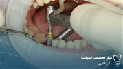 قیمت ایمپلنت آمریکایی در تهران  