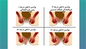 همه چیز درباره لیزر فیشر، جراح بواسیر و علت خارش مقعدی