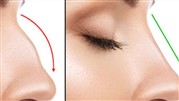 The best method of nose job