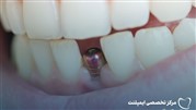 ایمپلنت سریعترین و بهترین جایگزین بی دندانی از نگاه متخصص