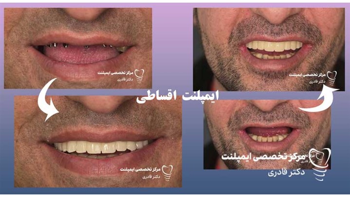 ایمپلنت فوری اقساطی؛ کاشت دندان سریع با پرداخت آسان