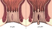 بررسی انواع شقاق یا فیشر مقعد 