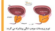 سرطان پروستات در مردان و مشکلات آن