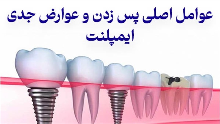 عوامل اصلی پس‌زدن و عوارض جدی ایمپلنت.