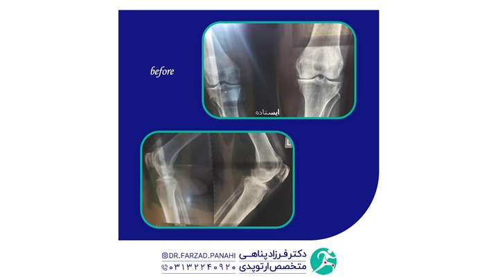 جراحی آرتروز زانو توسط بهترین متخصص ارتوپد اصفهان