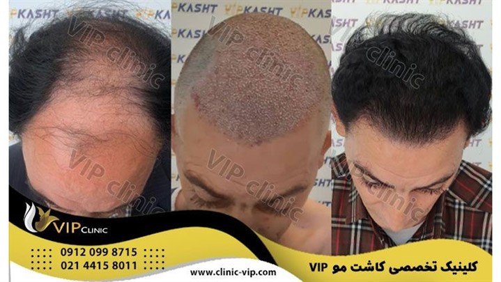 بهترین مرکز کاشت مو کجاست معیارهای انتخاب بهترین کلینیک کاشت مو