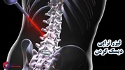 لیزر تراپی دیسک گردن و کمر در فیزیوتراپی