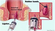 روش‌های کم تهاجمی درمان هموروئید یا بواسیر با رابربند و اسکلروتراپی