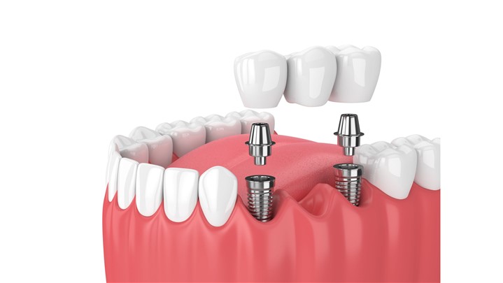 چه زمانی به ایمپلنت دندان نیاز است؟
