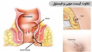 تفاوت دو بیماری فیستول و کیست مویی (سینوس پیلونیدال)