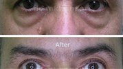 تاثیر عمل بلفاروپلاستی پلک پایین