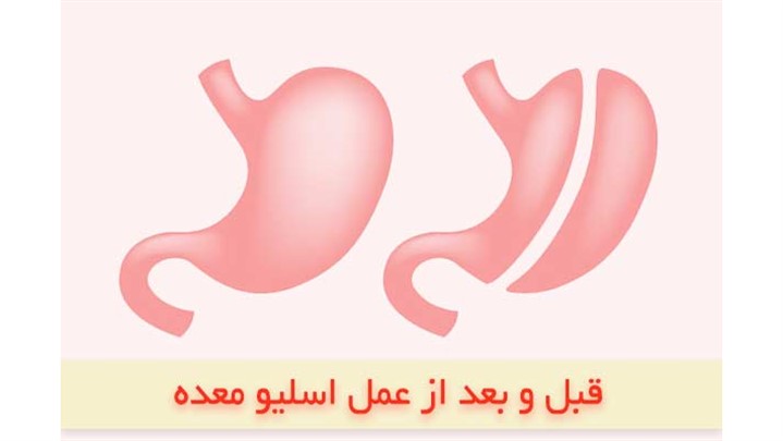 عمل اسلیو معده بهتر است یا بای پس معده؟