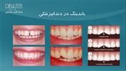باندینگ در دندانپزشکی