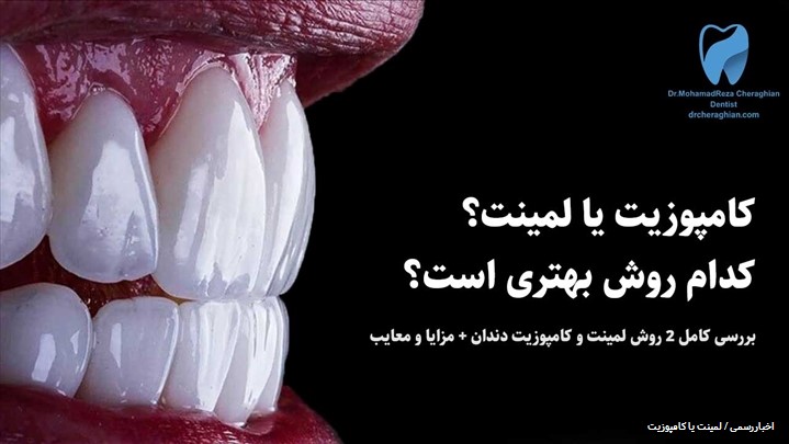 تفاوت کامپوزیت ونیر و لمینت سرامیکی چیست؟