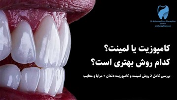 تفاوت کامپوزیت ونیر و لمینت سرامیکی چیست؟
