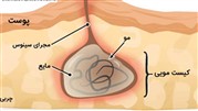  همه چیز درباره کیست مویی، کیست پستان و عمل فتق با لاپاراسکوپی