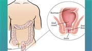  همه چیز درباره علت درد مقعد، بواسیر داخلی و عمل بواسیر