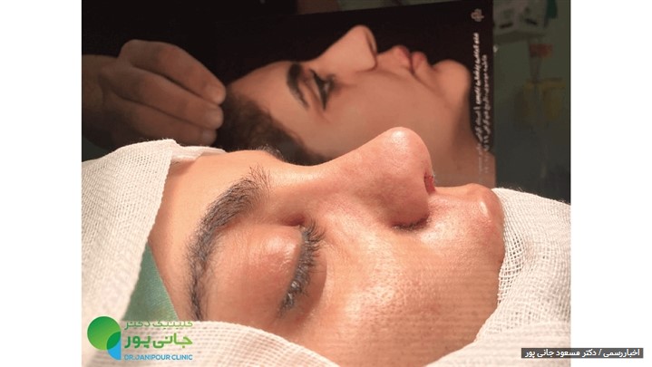 برطرف کردن کبودی صورت بعد از عمل بینی برطرف کردن کبودی صورت بعد از عمل بینی