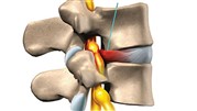 درمان دیسک و تنگی کانال بدون جراحی باز