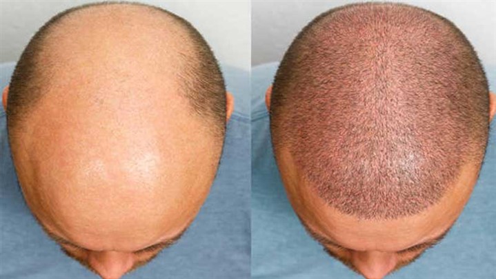 تجربه دلچسب کاشت مو: از انتخاب کلینیک تا نتیجه نهایی تجربه دلچسب کاشت مو: از انتخاب کلینیک تا نتیجه نهایی
