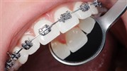 ارتودنسی فلزی چگونه عمل می کند؟