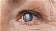 آب مروارید و کوری چشم؛ آیا می توان از نابینایی جلوگیری کرد؟
