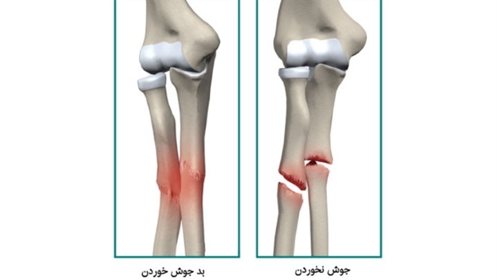 یکی از بدترین دردها، درد شکستگی استخوانها در هر جای بدن است. یکی از بدترین دردها، درد شکستگی استخوانها در هر جای بدن است.