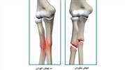 یکی از بدترین دردها، درد شکستگی استخوان‌ها در هر جای بدن است