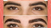 لیفت ابرو بدون جراحی