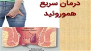 روش‌های درمان سریع و فوری درد بواسیر یا هموروئید