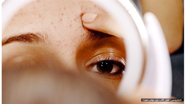 فواید گلاب برای جوش صورت