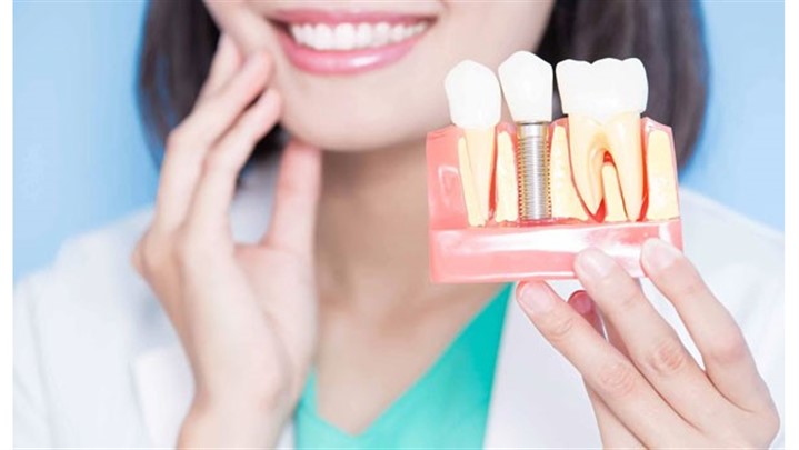 آیا ایمپلنت دندان شامل بیمه می‌شود؟