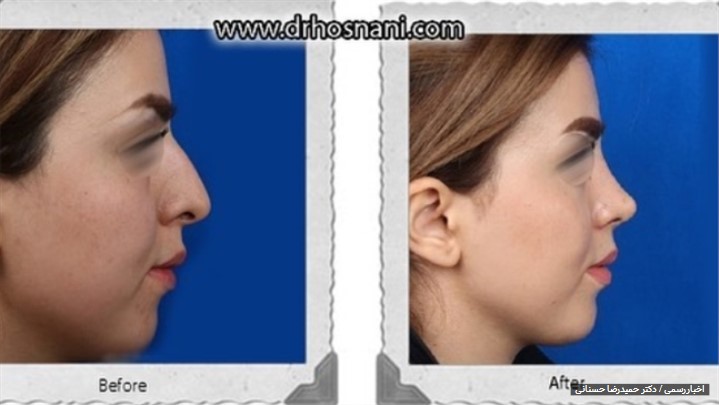 مهم ترین نکات درباره جراحی بینی مهم ترین نکات درباره جراحی بینی