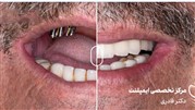  ایمپلنت همه دندانها را در سریعترین زمان 