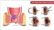 درمان بیماری بواسیر یا هموروئید با روش جراحی هموروئیدکتومی