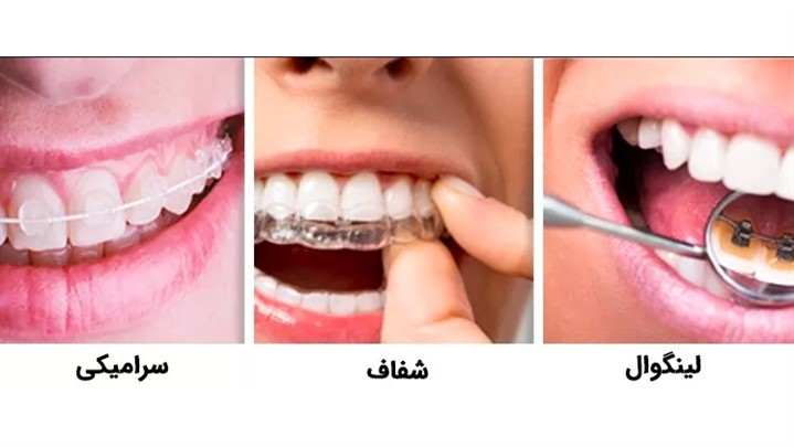 قبل از انجام ارتودنسی نامرئی یا مرئی مطالعه کنید! قبل از انجام ارتودنسی نامرئی یا مرئی مطالعه کنید!