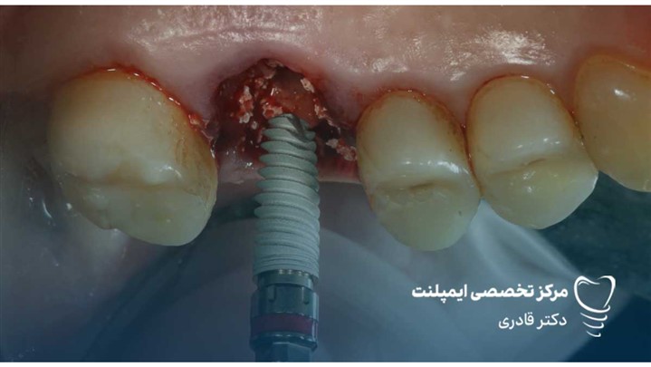 بهترین برند ایمپلنت کره ای | مقایسه تخصصی برندها و انتخاب هوشمندانه
