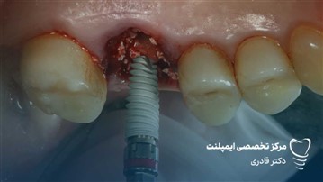 بهترین برند ایمپلنت کره ای | مقایسه تخصصی برندها و انتخاب هوشمندانه